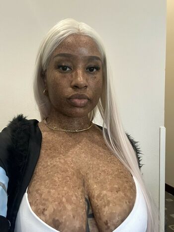 freckledn
