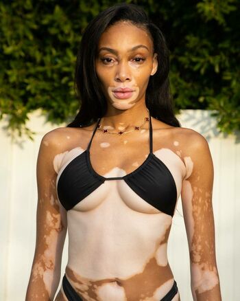 Winnie Harlow